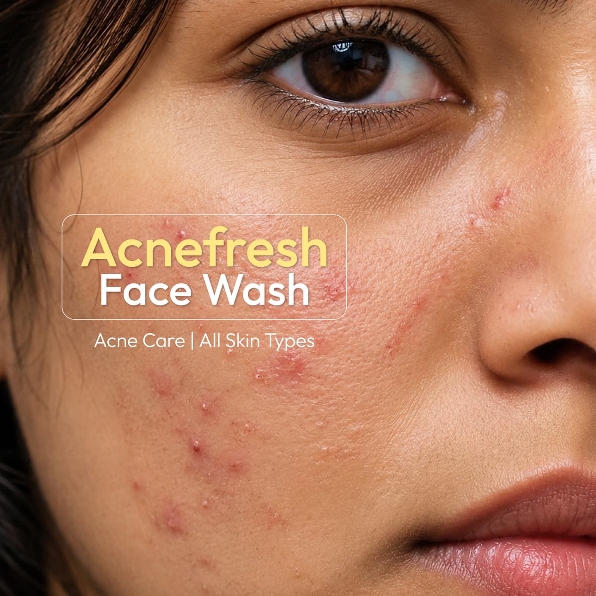 Acnifresh Face Wash — view 3